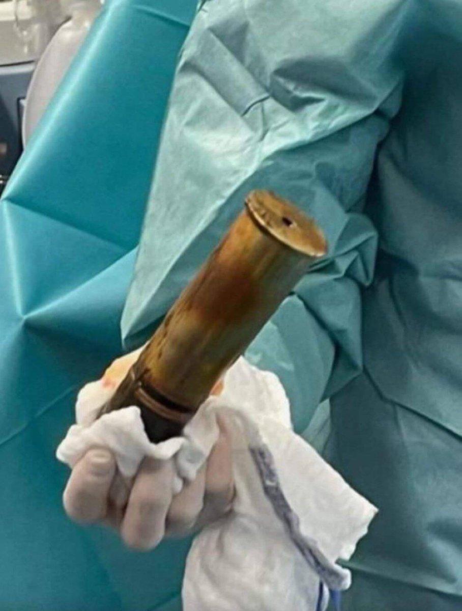 Fransa'da, 88 yaşındaki adamın makatından top mermisi çıkarıldı