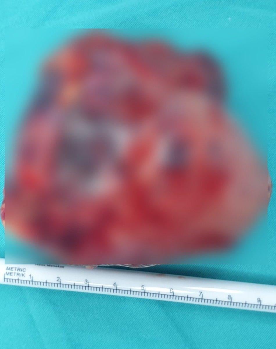 Bursa’da, 14 yaşında böbreğinden 9 santimetrelik kitle çıkarıldı