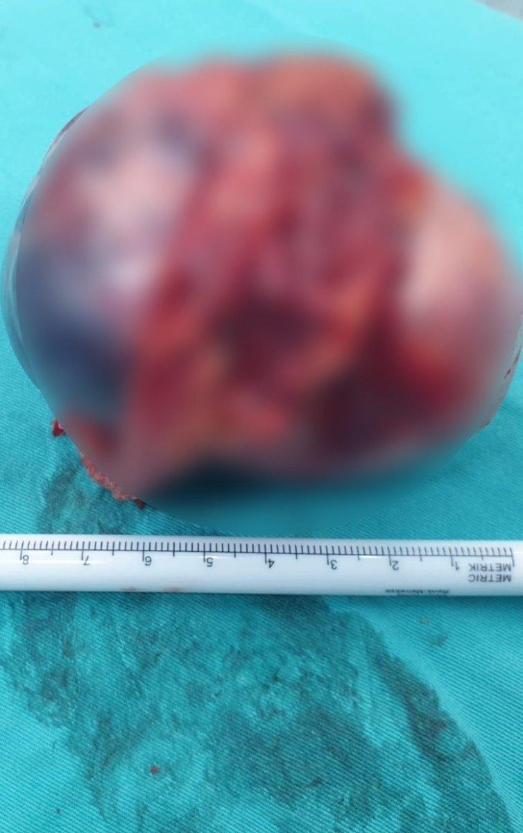 Bursa’da, 14 yaşında böbreğinden 9 santimetrelik kitle çıkarıldı