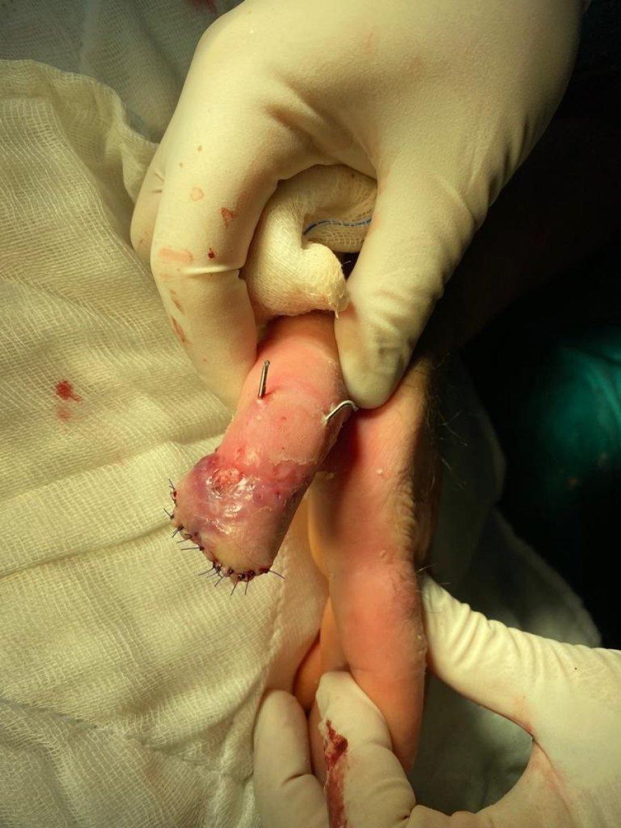 Sivas’ta kopan parmak, göbekte büyütüldü 