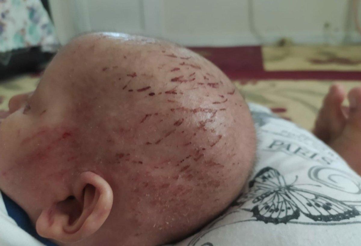 Mardin'de küçük çocuk, nadir görülen balık pulu hastalığıyla yaşıyor