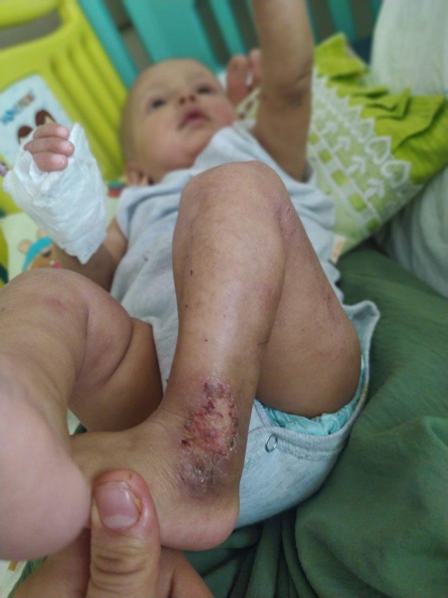 Mardin'de küçük çocuk, nadir görülen balık pulu hastalığıyla yaşıyor