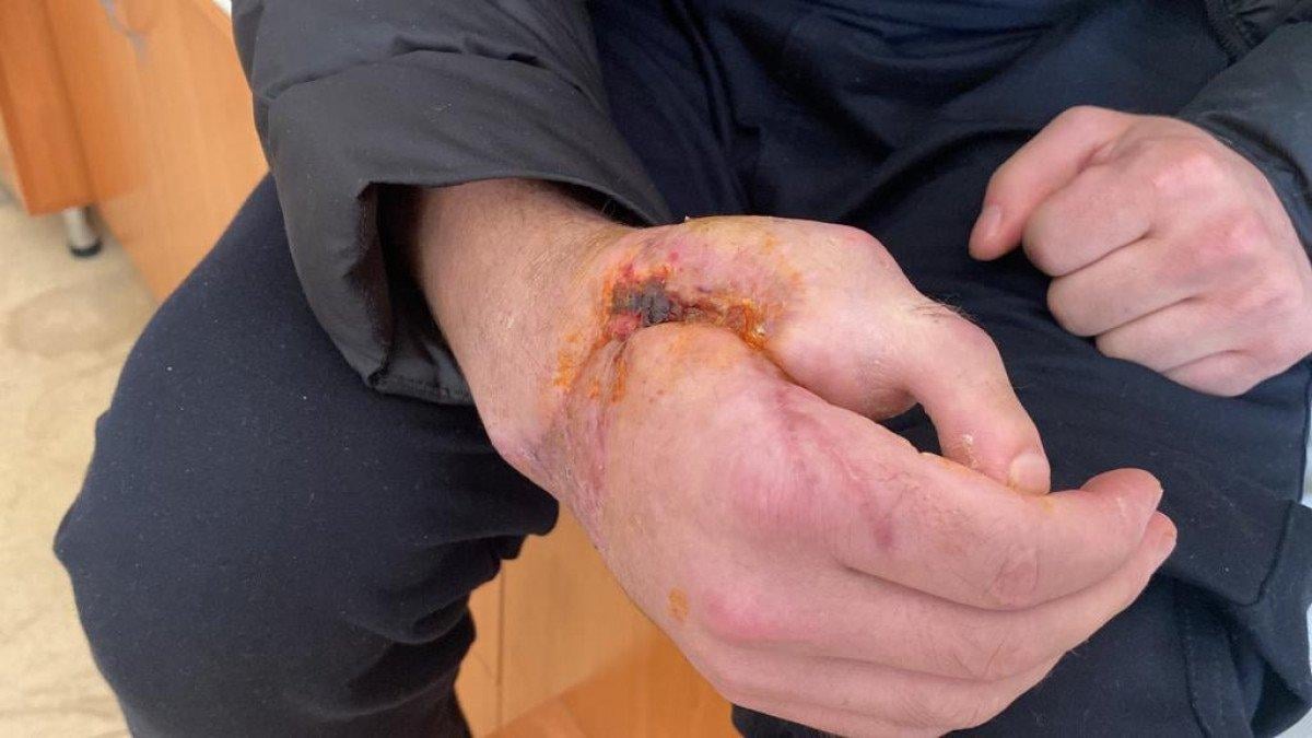 Konya'da kopan el parmağı yerine ayak parmağı nakledildi