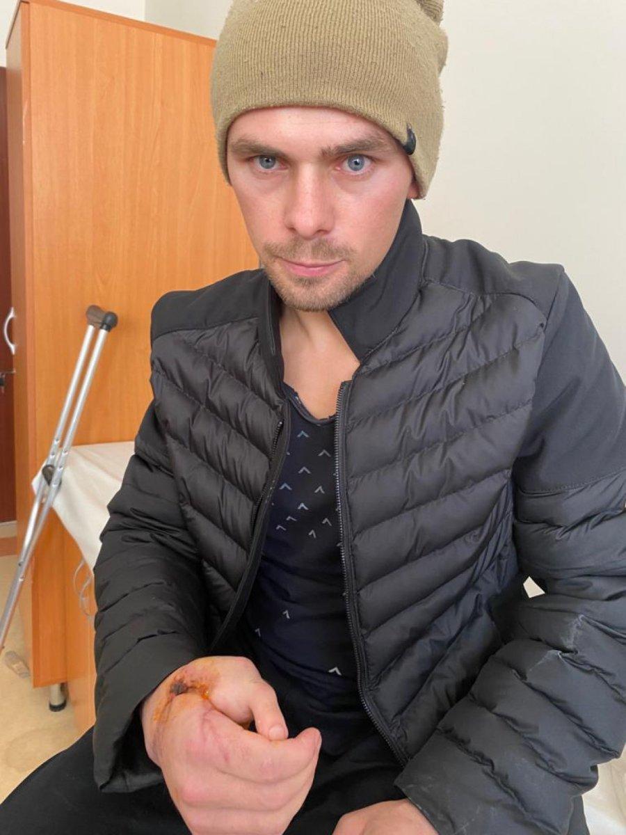 Konya'da kopan el parmağı yerine ayak parmağı nakledildi